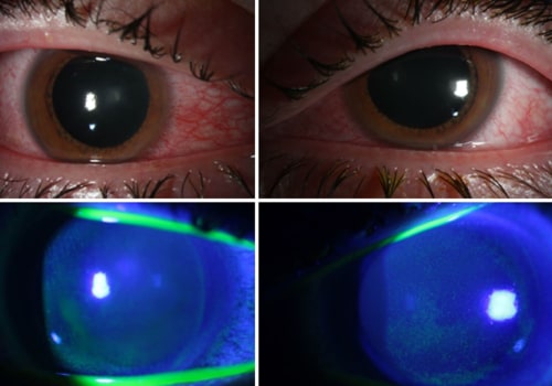 The Impact of UV Light Exposure on Human Health: An Expert's Perspective