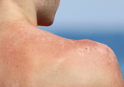 The Dangers of UV Light: How to Protect Yourself